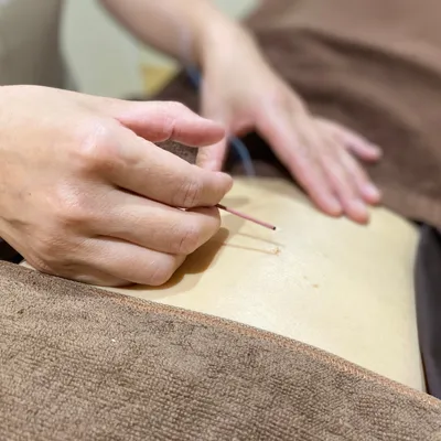 鍼灸施術の様子
